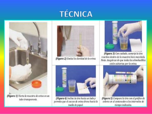 Tiras reactivas y examen microscópico "Orina"