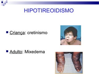 HIPOTIREOIDISMO
 Criança: cretinismo
 Adulto: Mixedema
 