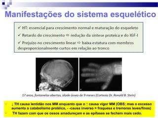 Manifestações do sistema esquelético
- ↓ TH causa lentidão nos MM enquanto que o ↑ causa vigor MM (OBS: mas o excesso
aumenta o catabolismo protéico, - -causa inverso = fraquesa e tremores leves/finos)
- TH fazem com que os ossos amadureçam e as epífases se fechem mais cedo.
 