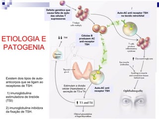 Estimulam a divisão
celular (hiperplasia) e
secreção de T3 e T4
Defeito genético que
causa falta de ação
das células T
supressoras
Células B
produzem AC
anti-receptor
TSH
Existem dois tipos de auto-
anticorpos que se ligam ao
receptores de TSH:
1) imunoglobulina
estimuladora de tireóide
(TSI)
2) imunoglobulina inibidora
da fixação de TSH.
Auto-AC anti
receptor TSH
Auto-AC anti receptor TSH
no tecido retrorbital
ETIOLOGIA E
PATOGENIA
 