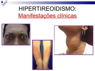 HIPERTIREOIDISMO:
Manifestações clínicas
 