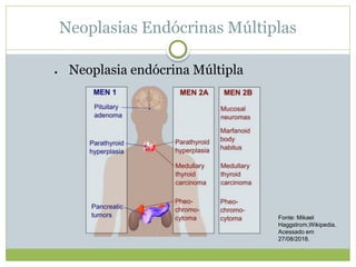 Neoplasias Endócrinas Múltiplas
 Neoplasia endócrina Múltipla
Fonte: Mikael
Haggstrom,Wikipedia.
Acessado em
27/08/2018.
 