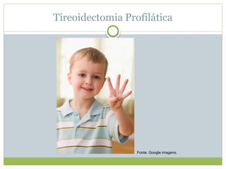 Tireoidectomia Profilática
Fonte: Google imagens.
 