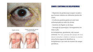 - Depósitos de gordura que surgem na pele e
que formam nódulos em diferentes pontos do
corpo;
- O olho do paciente ganha um anel mais
esbranquiçado ao redor da córnea;
- Aumento do fígado ou do baço;
- Sensação de queimação e formigamento em
mãos e pés.
As dislipidemias, geralmente, não causam
sintomas. Por isso, pessoas dos grupos de risco
devem consultar o médico e realizar os exames
única forma segura de identificar as
dislipidemias é por meio de exames de sangue
periódicos.
SINAIS E SINTOMAS DE DISLIPIDEMIAS
 
