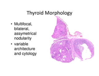 Thyroid Morphology
• Multifocal,
  bilateral,       1
  assymetrical
  nodularity
• variable
  architecture         3     2
  and cytology
 