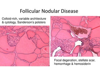 Follicular Nodular Disease
Colloid-rich, variable architecture
& cytology, Sanderson’s polsters




                                      Focal degeration, stellate scar,
                                      hemorrhage & hemosiderin
 