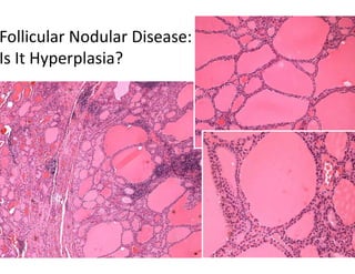 Follicular Nodular Disease:
Is It Hyperplasia?
 