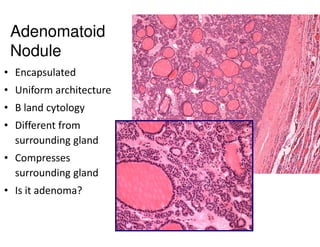Adenomatoid
 Nodule
• Encapsulated
• Uniform architecture
• B land cytology
• Different from
  surrounding gland
• Compresses
  surrounding gland
• Is it adenoma?
 