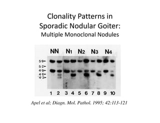 Clonality Patterns in
    Sporadic Nodular Goiter:
    Multiple Monoclonal Nodules




Apel et al; Diagn. Mol. Pathol. 1995; 42:113-121
 