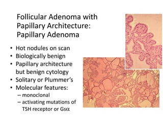 Follicular Adenoma with
  Papillary Architecture:
  Papillary Adenoma
• Hot nodules on scan
• Biologically benign
• Papillary architecture
  but benign cytology
• Solitary or Plummer’s
• Molecular features:
  – monoclonal
  – activating mutations of
    TSH receptor or Gsα
 