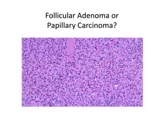Follicular Adenoma or
Papillary Carcinoma?
 