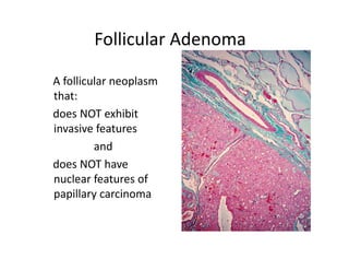 Follicular Adenoma

A follicular neoplasm
that:
does NOT exhibit
invasive features
         and
does NOT have
nuclear features of
papillary carcinoma
 
