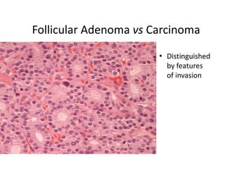 Follicular Adenoma vs Carcinoma
                       • Distinguished
                         by features
                         of invasion
 
