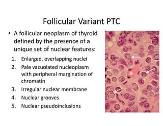 Follicular Variant PTC
• A follicular neoplasm of thyroid
  defined by the presence of a
  unique set of nuclear features:
 1. Enlarged, overlapping nuclei
 2. Pale vacuolated nucleoplasm
    with peripheral margination of
    chromatin
 3. Irregular nuclear membrane
 4. Nuclear grooves
 5. Nuclear pseudoinclusions
 