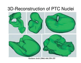 3D-Reconstruction of PTC Nuclei




         Virchows Arch (2004) 444:350
                              444:350–355
 