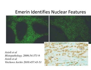 Emerin Identifies Nuclear Features




Asioli et al
Histopathology. 2009;54:571-9
Asioli et al
Virchows Archiv 2010:457:43-51
 