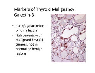Markers of Thyroid Malignancy:
 Galectin-3

• 31kD β-galactoside-
  binding lectin
• High percentage of
  malignant thyroid
  tumors, not in
  normal or benign
  lesions
 