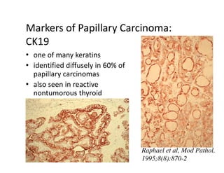 Markers of Papillary Carcinoma:
CK19
• one of many keratins
• identified diffusely in 60% of
  papillary carcinomas
• also seen in reactive
  nontumorous thyroid




                                   Raphael et al, Mod Pathol.
                                   1995;8(8):870-2
 