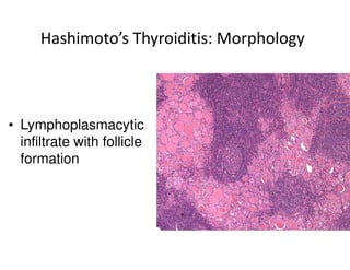 Hashimoto’s Thyroiditis: Morphology



• Lymphoplasmacytic
  infiltrate with follicle
  formation
 