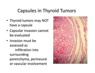 Capsules in Thyroid Tumors
• Thyroid tumors may NOT
  have a capsule
• Capsular invasion cannot
  be evaluated
• Invasion must be
  assessed as
      infiltration into
  surrounding
  parenchyma, perineural
  or vascular involvement
 