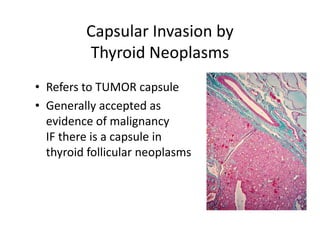 Capsular Invasion by
         Thyroid Neoplasms
• Refers to TUMOR capsule
• Generally accepted as
  evidence of malignancy
  IF there is a capsule in
  thyroid follicular neoplasms
 