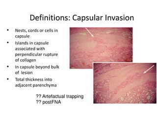Definitions: Capsular Invasion
•   Nests, cords or cells in
    capsule
•   Islands in capsule
    associated with
    perpendicular rupture
    of collagen
•   In capsule beyond bulk
    of lesion
•   Total thickness into
    adjacent parenchyma

               ?? Artefactual trapping
               ?? postFNA
 