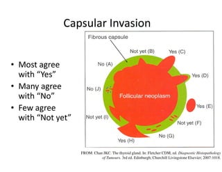 Capsular Invasion


• Most agree
  with “Yes”
• Many agree
  with “No”
• Few agree
  with “Not yet”


                   FROM: Chan JKC. The thyroid gland. In: Fletcher CDM, ed. Diagnostic Histopathology
                             of Tumours. 3rd ed. Edinburgh; Churchill Livingstone Elsevier; 2007:1018.
 