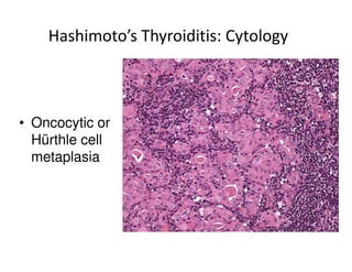 Hashimoto’s Thyroiditis: Cytology



• Oncocytic or
  Hürthle cell
  metaplasia
 