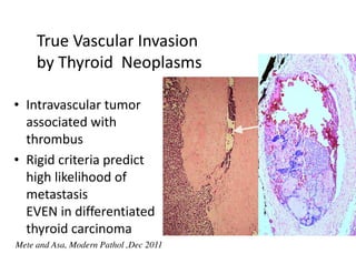 True Vascular Invasion
     by Thyroid Neoplasms

• Intravascular tumor
  associated with
  thrombus
• Rigid criteria predict
  high likelihood of
  metastasis
  EVEN in differentiated
  thyroid carcinoma
Mete and Asa, Modern Pathol ,Dec 2011
 