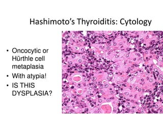 Hashimoto’s Thyroiditis: Cytology


• Oncocytic or
  Hürthle cell
  metaplasia
• With atypia!
• IS THIS
  DYSPLASIA?
 