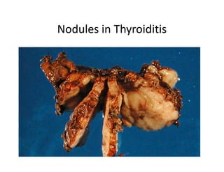 Nodules in Thyroiditis
 