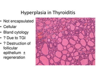 Hyperplasia in Thyroiditis
•   Not encapsulated
•   Cellular
•   Bland cytology
•   ? Due to TGI
•   ? Destruction of
    follicular
    epithelium ±
    regeneration
 