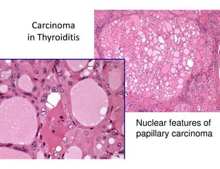 Carcinoma
in Thyroiditis




                 Nuclear features of
                 papillary carcinoma
 