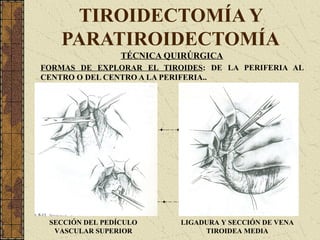TIROIDECTOMÍA Y
PARATIROIDECTOMÍA
TÉCNICA QUIRÚRGICA
FORMAS DE EXPLORAR EL TIROIDES: DE LA PERIFERIA AL
CENTRO O DEL CENTRO A LA PERIFERIA..
SECCIÓN DEL PEDÍCULO
VASCULAR SUPERIOR
LIGADURA Y SECCIÓN DE VENA
TIROIDEA MEDIA
 