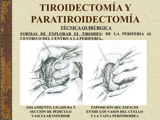 TIROIDECTOMÍA Y
PARATIROIDECTOMÍA
TÉCNICA QUIRÚRGICA
FORMAS DE EXPLORAR EL TIROIDES: DE LA PERIFERIA AL
CENTRO O DEL CENTRO A LA PERIFERIA..
AISLAMIENTO, LIGADURA Y
SECCIÓN DE PEDÍCULO
VASCULAR INFERIOR
EXPOSICIÓN DEL ESPACIO
ENTRE LOS VASOS DEL CUELLO
Y LA VAINA PERITIROIDEA
 