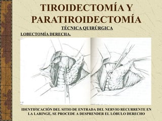 TIROIDECTOMÍA Y
PARATIROIDECTOMÍA
TÉCNICA QUIRÚRGICA
LOBECTOMÍA DERECHA.
IDENTIFICACIÓN DEL SITIO DE ENTRADA DEL NERVIO RECURRENTE EN
LA LARINGE, SE PROCEDE A DESPRENDER EL LÓBULO DERECHO
 