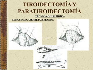 TIROIDECTOMÍA Y
PARATIROIDECTOMÍA
TÉCNICA QUIRÚRGICA
HEMOSTASIA, CIERRE POR PLANOS..
 