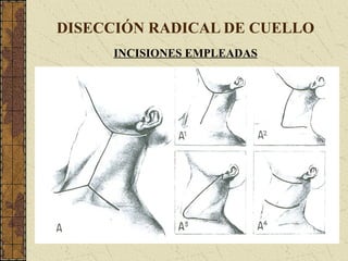 DISECCIÓN RADICAL DE CUELLO
INCISIONES EMPLEADAS
 