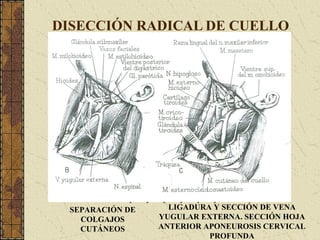 DISECCIÓN RADICAL DE CUELLO
SEPARACIÓN DE
COLGAJOS
CUTÁNEOS
LIGADURA Y SECCIÓN DE VENA
YUGULAR EXTERNA. SECCIÓN HOJA
ANTERIOR APONEUROSIS CERVICAL
PROFUNDA
 