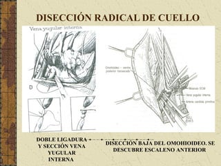 DISECCIÓN RADICAL DE CUELLO
DOBLE LIGADURA
Y SECCIÓN VENA
YUGULAR
INTERNA
DISECCIÓN BAJA DEL OMOHIOIDEO. SE
DESCUBRE ESCALENO ANTERIOR
 