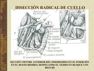 DISECCIÓN RADICAL DE CUELLO
SECCIÓN VIENTRE ANTERIOR DEL OMOHIOIDEO EN SU INSERCIÓN
EN EL HUESO HIOIDES, DESPEGANDO EL TEJIDO EN BLOQUE CON
BISTURÍ
 