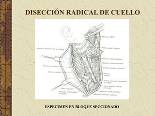DISECCIÓN RADICAL DE CUELLO
ESPECIMEN EN BLOQUE SECCIONADO
 