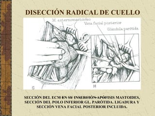 DISECCIÓN RADICAL DE CUELLO
SECCIÓN DEL ECM EN SU INSERCIÓN APÓFISIS MASTOIDES,
SECCIÓN DEL POLO INFERIOR GL. PARÓTIDA. LIGADURA Y
SECCIÓN VENA FACIAL POSTERIOR INCLUIDA.
 
