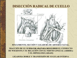 DISECCIÓN RADICAL DE CUELLO
PINZAMIENTO, SECCIÓN Y LIGADURA DE ARTERIA FACIAL.
TRACCIÓN DE GL SUBMAXILAR (PARA DESCUBRIR EL CONDUCTO
DE WHARTON) Y SU RELACIÓN CON EL NERVIO LINGUAL (ARRIBA)
Y EL HIPOGLOSO (ABAJO)
LIGADURA DOBLE Y TRANSFIXIÓN DE YUGULAR INTERNA
 