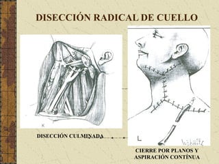 DISECCIÓN RADICAL DE CUELLO
DISECCIÓN CULMINADA
CIERRE POR PLANOS Y
ASPIRACIÓN CONTÍNUA
 