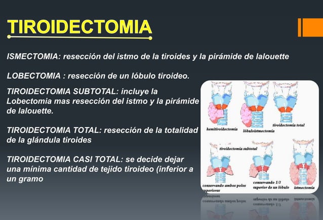 Tiroidectomia