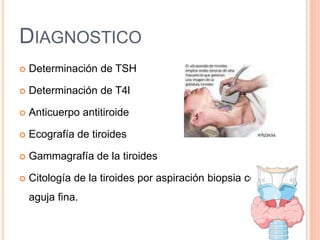 DIAGNOSTICO
 Determinación de TSH
 Determinación de T4l
 Anticuerpo antitiroide
 Ecografía de tiroides
 Gammagrafía de la tiroides
 Citología de la tiroides por aspiración biopsia con
aguja fina.
 