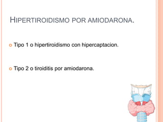 HIPERTIROIDISMO POR AMIODARONA.
 Tipo 1 o hipertiroidismo con hipercaptacion.
 Tipo 2 o tiroiditis por amiodarona.
 