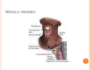 NÓDULO TIROIDEO
 