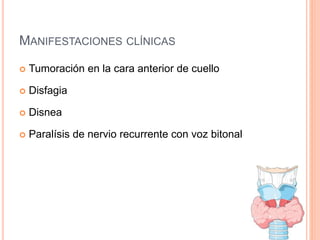 MANIFESTACIONES CLÍNICAS
 Tumoración en la cara anterior de cuello
 Disfagia
 Disnea
 Paralísis de nervio recurrente con voz bitonal
 